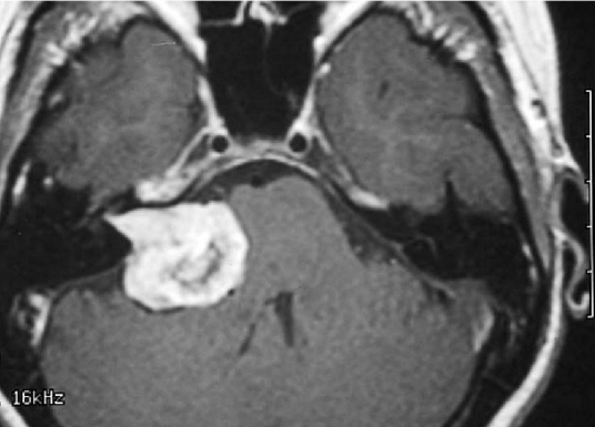 acoustic_neuroma cropped